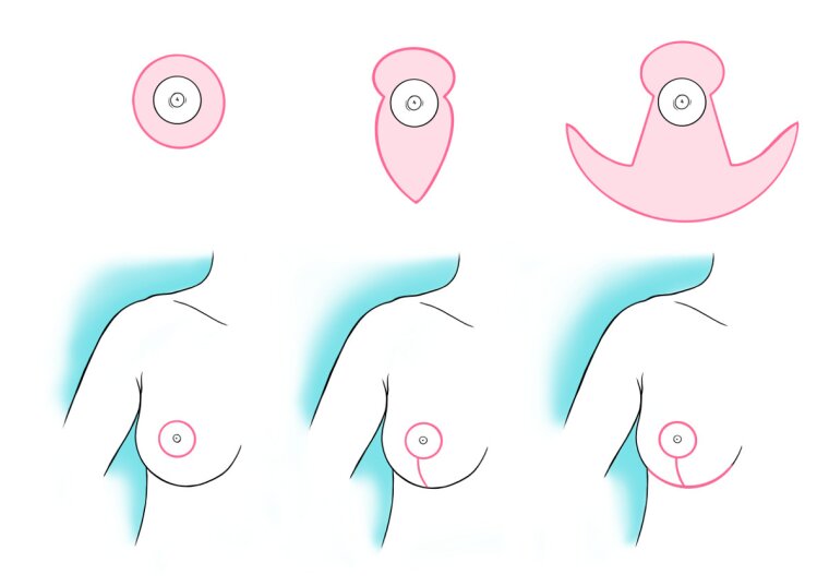 Surgical sketch illustrating a breast reduction and/or uplift