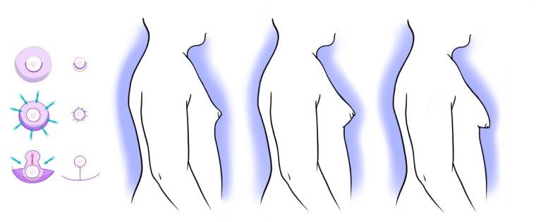 Surgical sketch illustrating a male breast tissue reduction