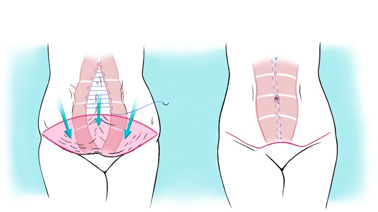 Surgical sketch illustrating a tummy tuck