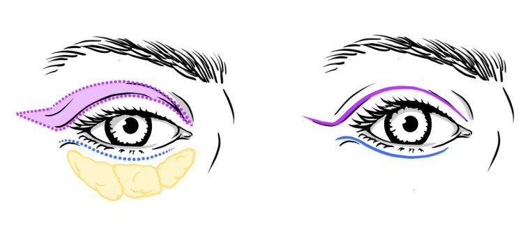 Surgical sketch illustrating an eyelid correction