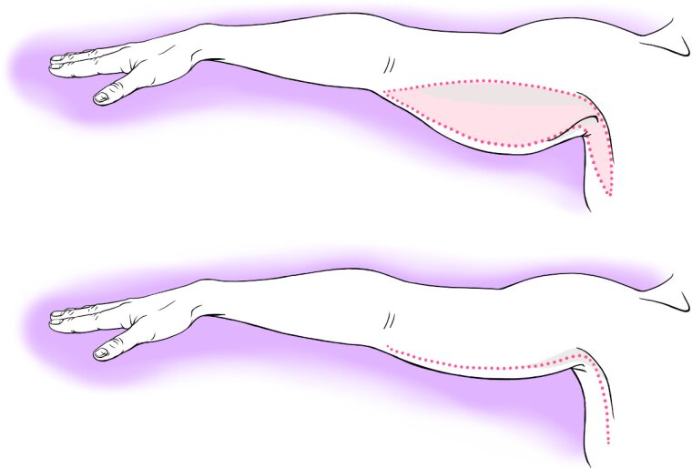 Surgical sketch illustrating an upper arm reduction