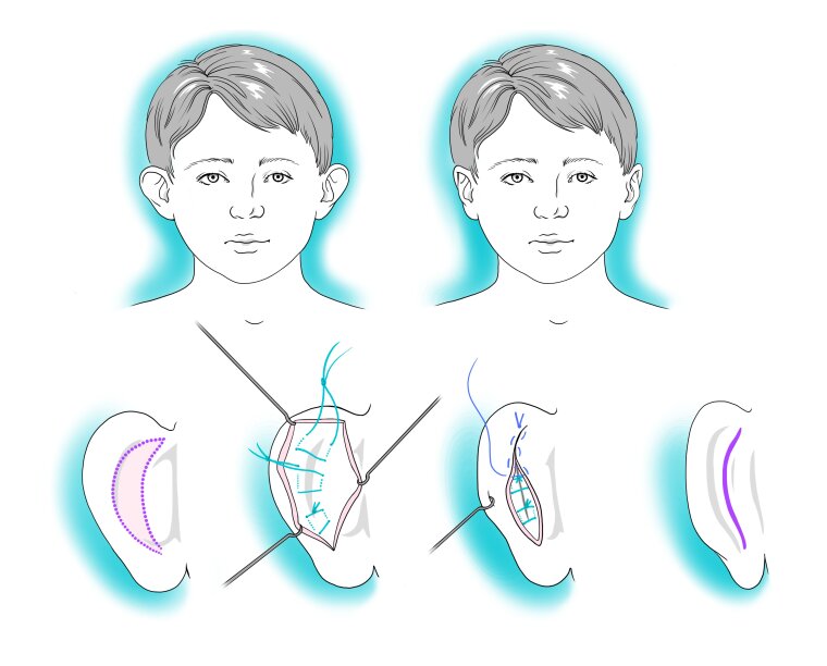 Surgical sketch illustrating prominent ear correction