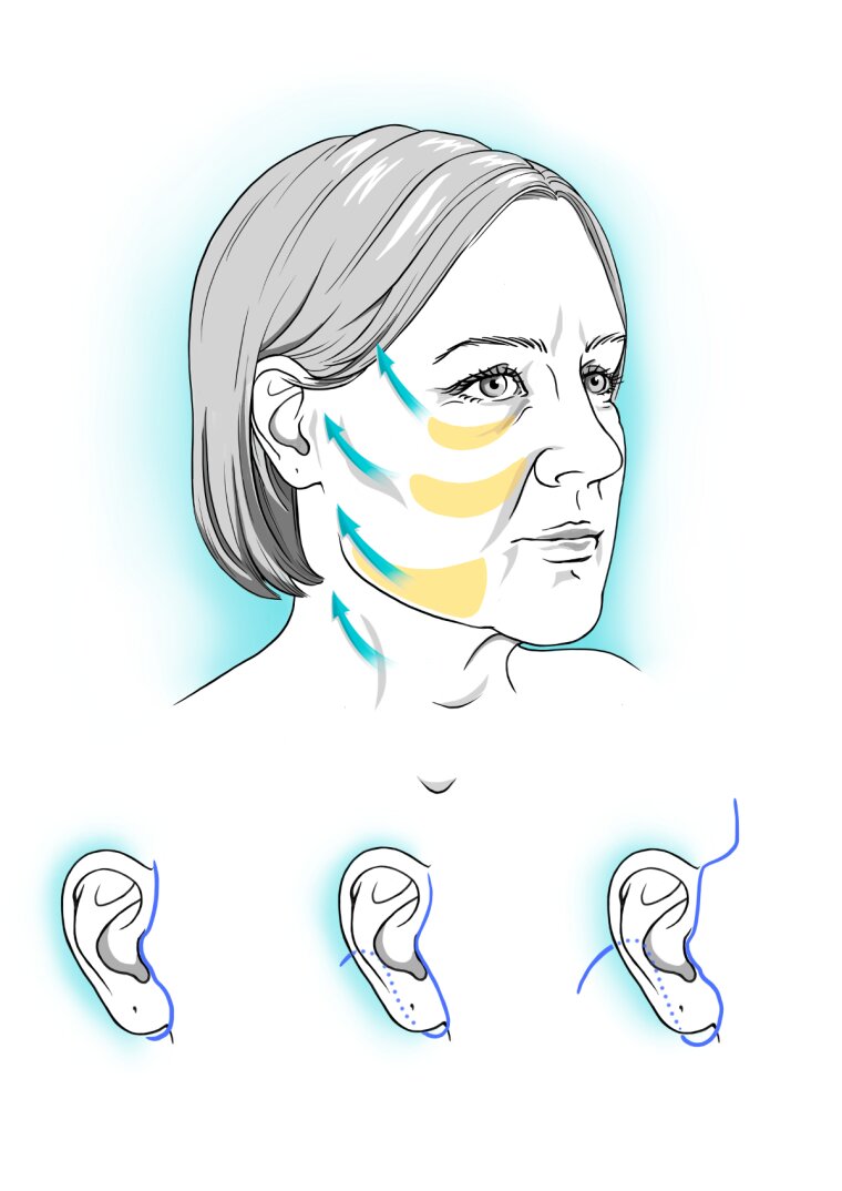 Surgical sketch illustrating a face and neck lift