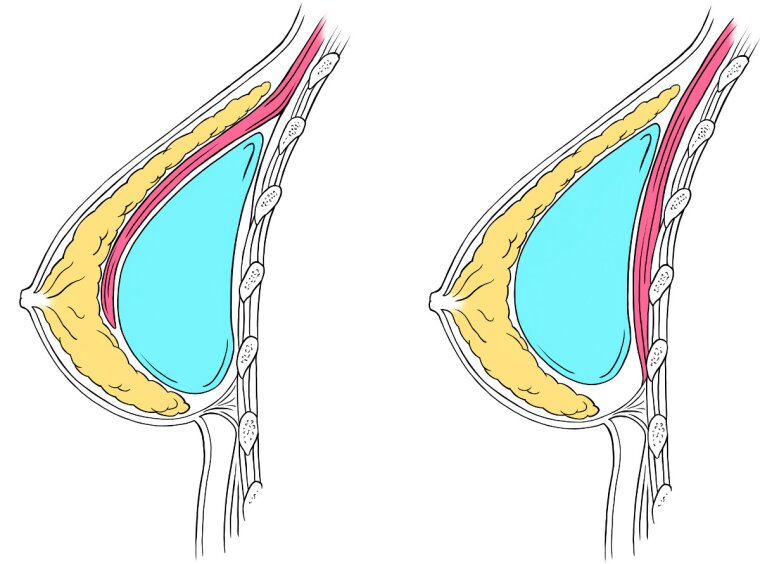 Surgical sketch illustrating two approaches for breat implants