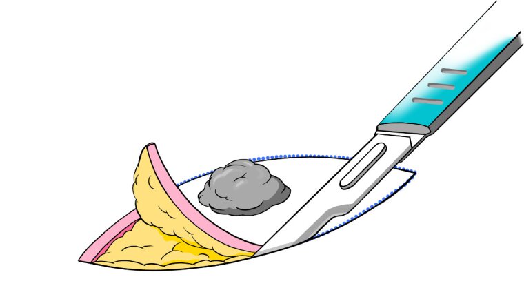 Surgical sketch illustrating a minor surgical procedure