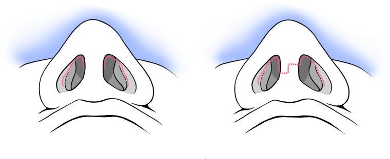 Surgical sketch illustrating a nose reshaping